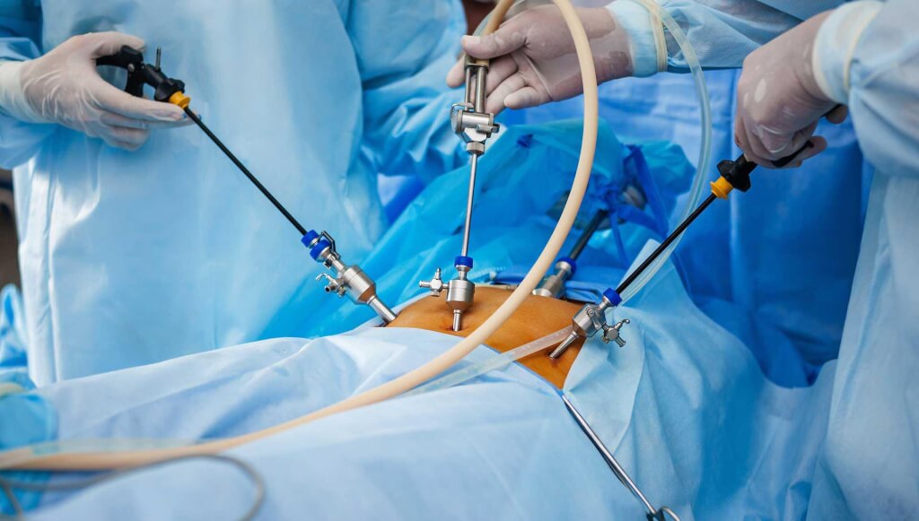 Laparoscopic