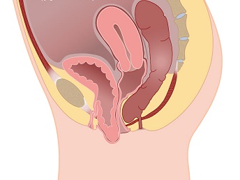 Cystocele