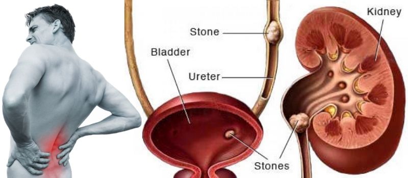 Kidney Stone