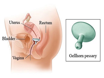 Pelvic