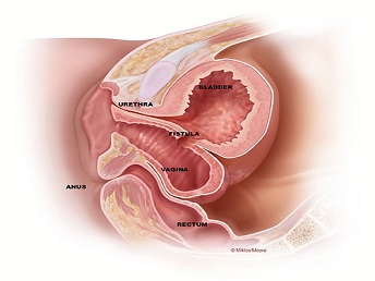 Fistula