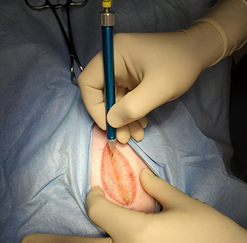 Laser Treatment